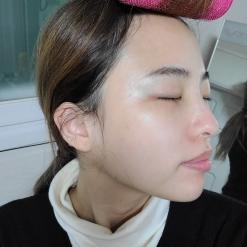 압구정 피부과_2회차 포텐자 후기 피부결 개선에 최고! (통증, 붓기, 엠보)