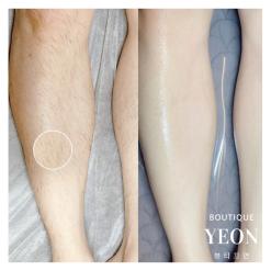 다리왁싱 시술 효과! 왁싱은 모량, 모두께가 줄어들어요