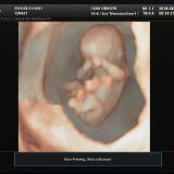 임신 11주 0일) 1차 기형아검사 입체초음파 목투명대검사