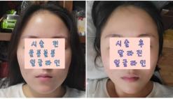서현 피부과 턱보톡스 인모드 리프팅 탄력 레이저 FX고주파포마모드 이중턱 광대 브이핏 윤곽주사 멍, 붓기, 효과