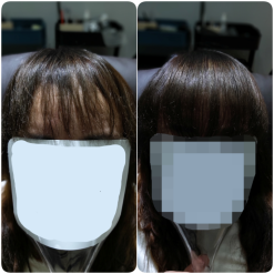 79가닥의 신기한 탈모커버[헤어증모술]강북증모술,수유증모술,위그위그에서 만나보세요.